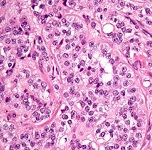 Picture of a tumour for Your Expert Witness story